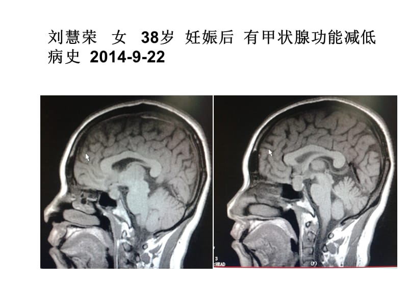 妊娠合并甲状腺功能减低与垂体形态ppt课件_第1页