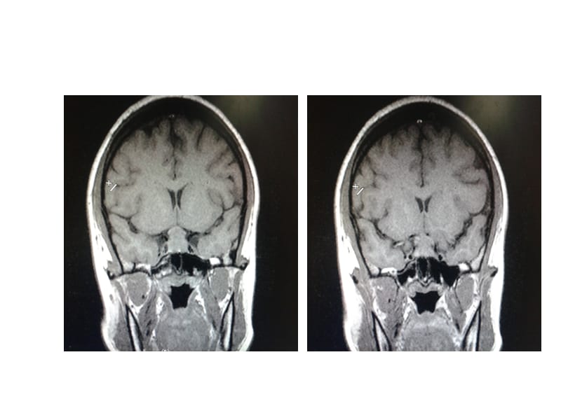 妊娠合并甲状腺功能减低与垂体形态ppt课件_第2页