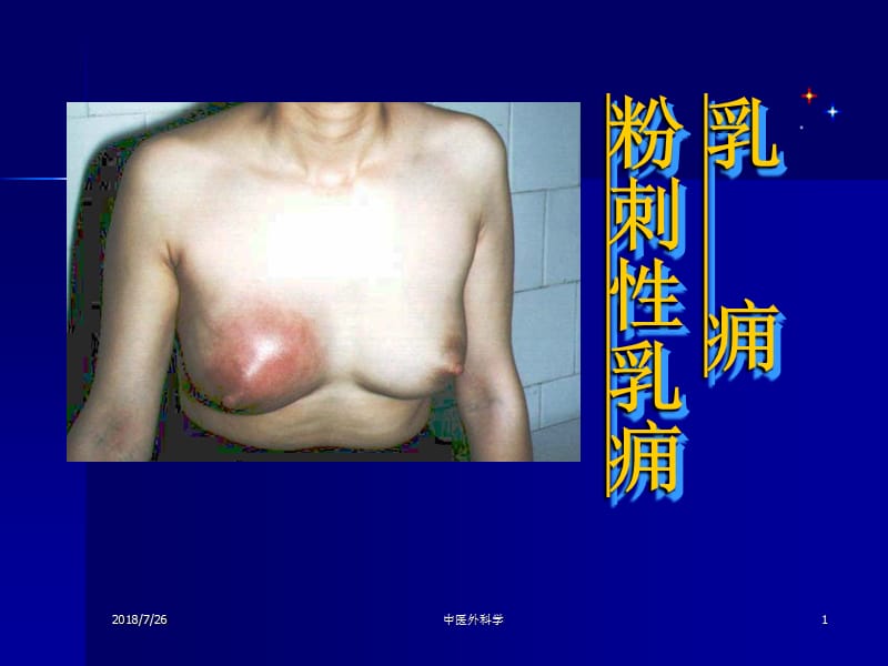 乳痈ppt课件_第1页