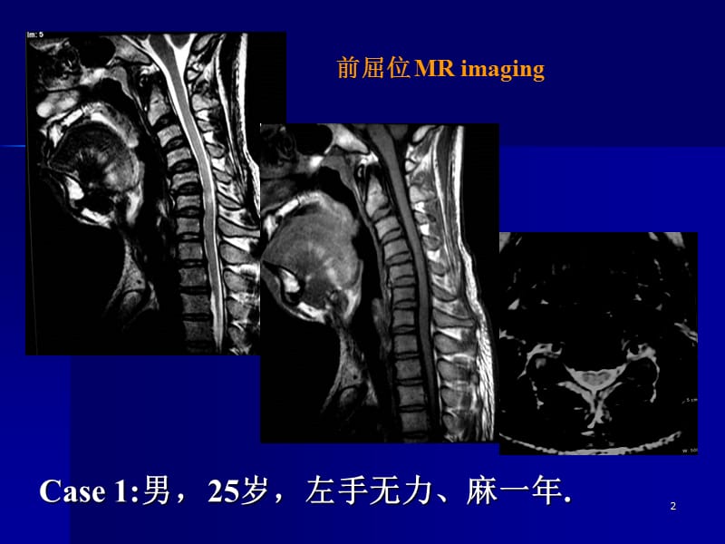 平山病PPT课件_第2页