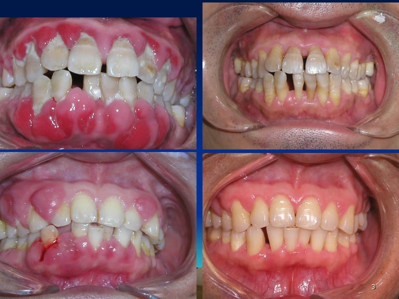 六牙周疾病 ppt课件_第3页