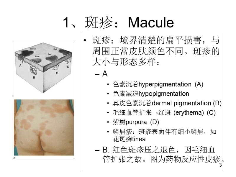 皮肤基本病理改变PPT课件_第3页