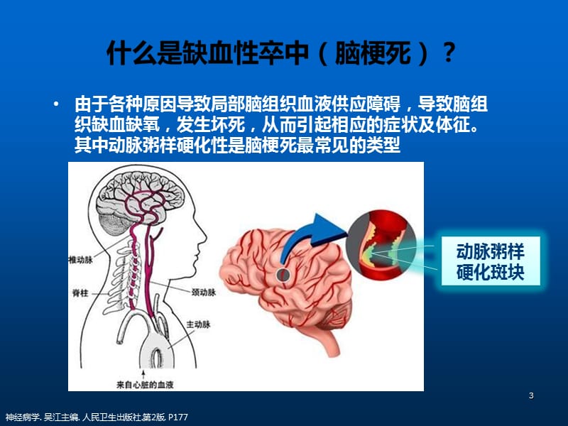 缺血性卒中患者教育病房PPT课件_第3页