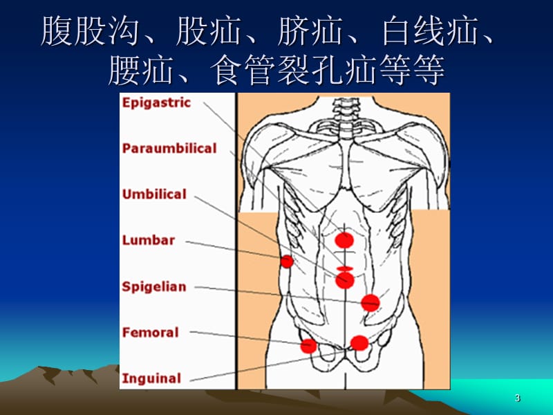 疝和腹壁外科进展PPT课件_第3页