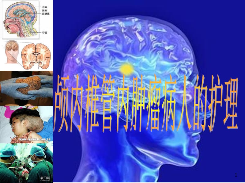 颅内肿瘤及蛛网膜下腔出血PPT课件_第1页