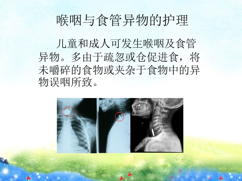 食管异物及食管镜检查的护理PPT课件_第2页