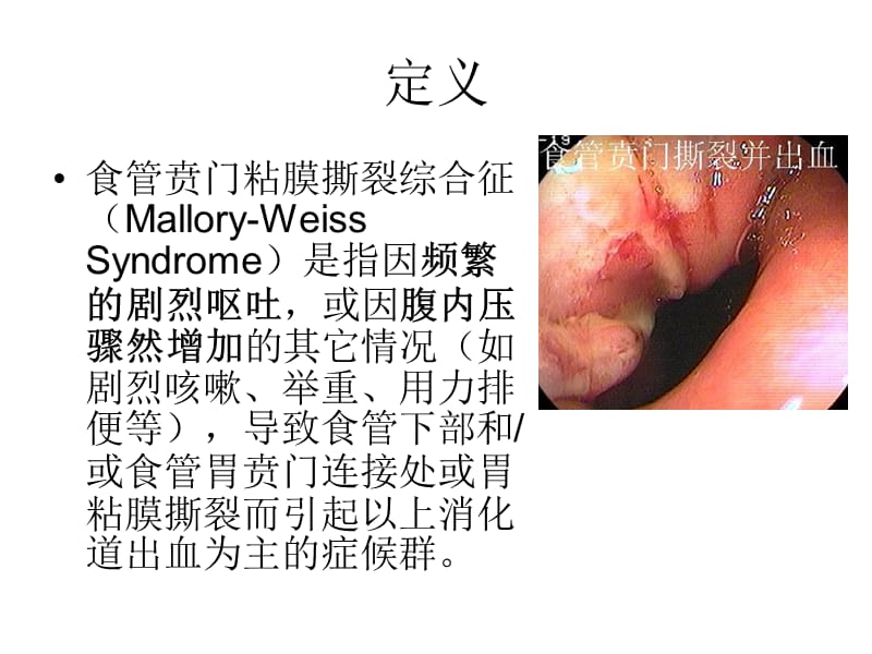 食管贲门粘膜撕裂综合征ppt课件_第2页