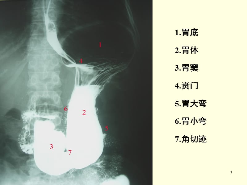 胃疾病影像ppt课件_第1页