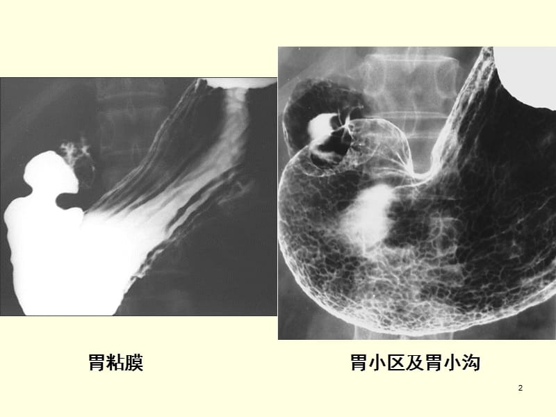 胃疾病影像ppt课件_第2页