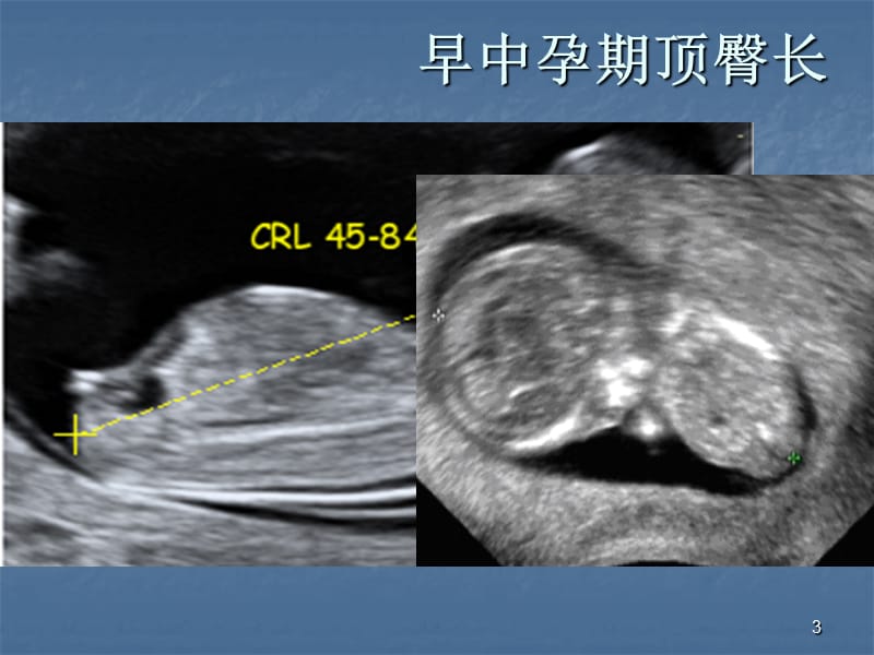 胎儿生长监测PPT课件_第3页