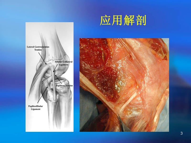 膝关节后外侧韧带结构损伤PPT课件_第3页