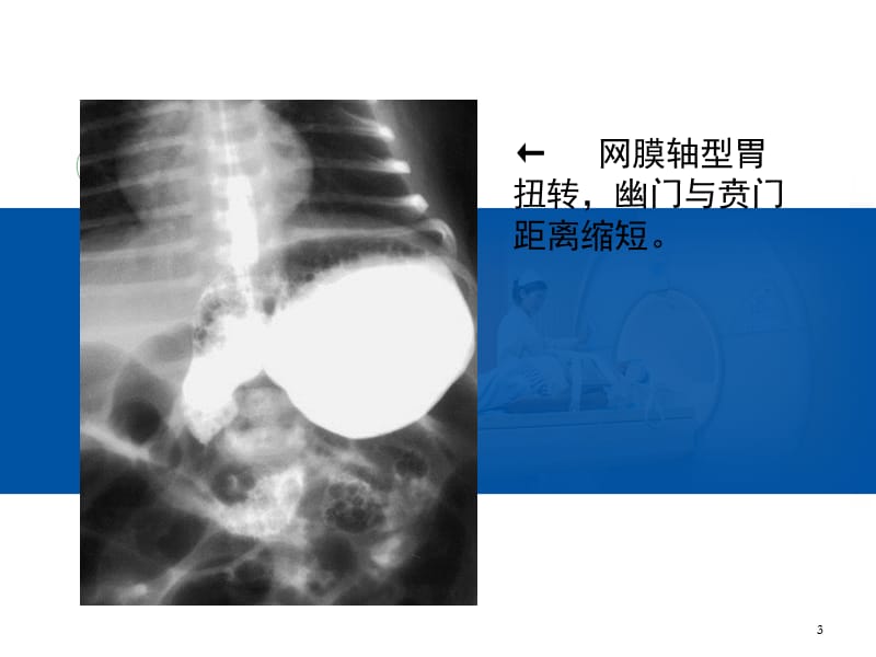 小儿常见消化道畸形影像表现ppt课件_第3页