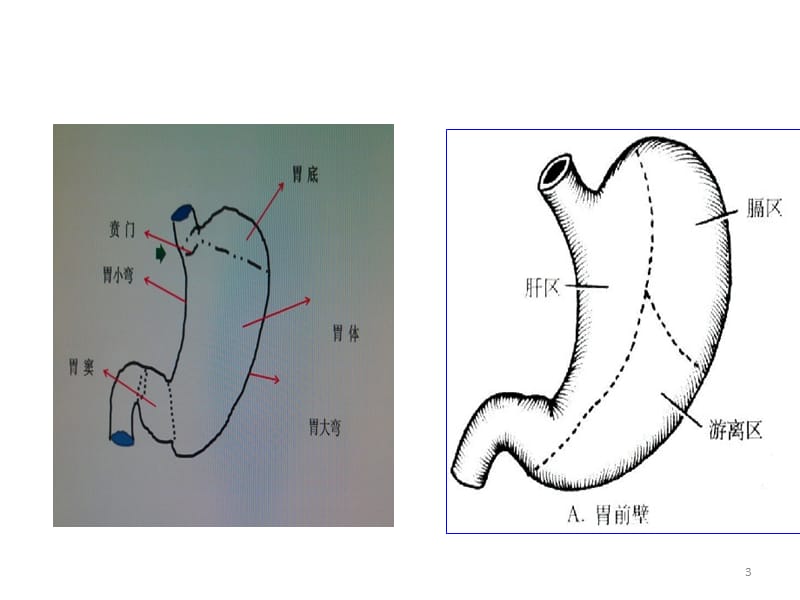 胃大部切除术的各种手术步骤ppt课件_第3页