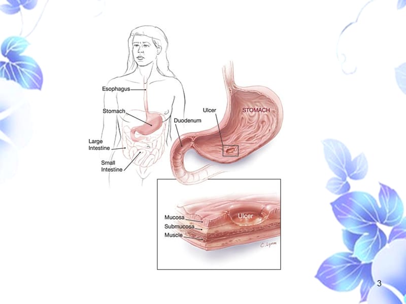 消化性溃疡病人的护理PPT课件_第3页