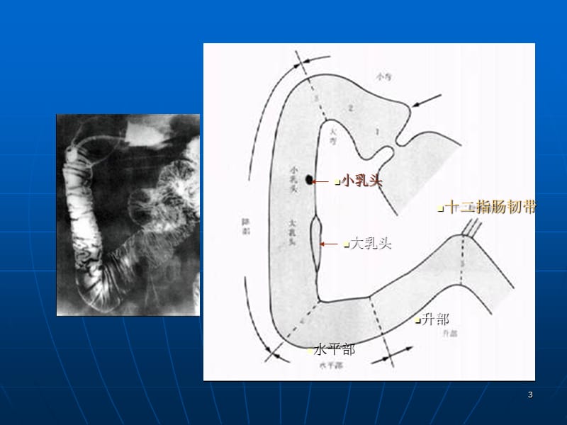 十二指肠疾病 ppt课件_第3页