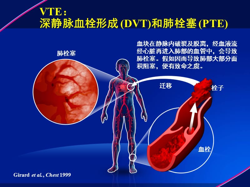 深静脉血栓防治解读PPT演示课件_第3页