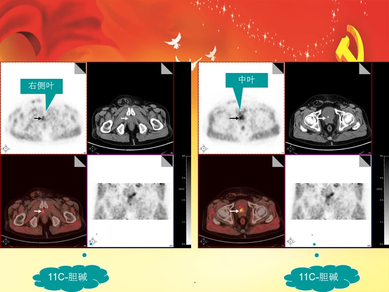 胆碱 PET CT 前列腺癌PPT演示课件_第3页