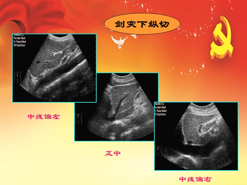 超声肝胆胰脾PPT演示课件_第3页