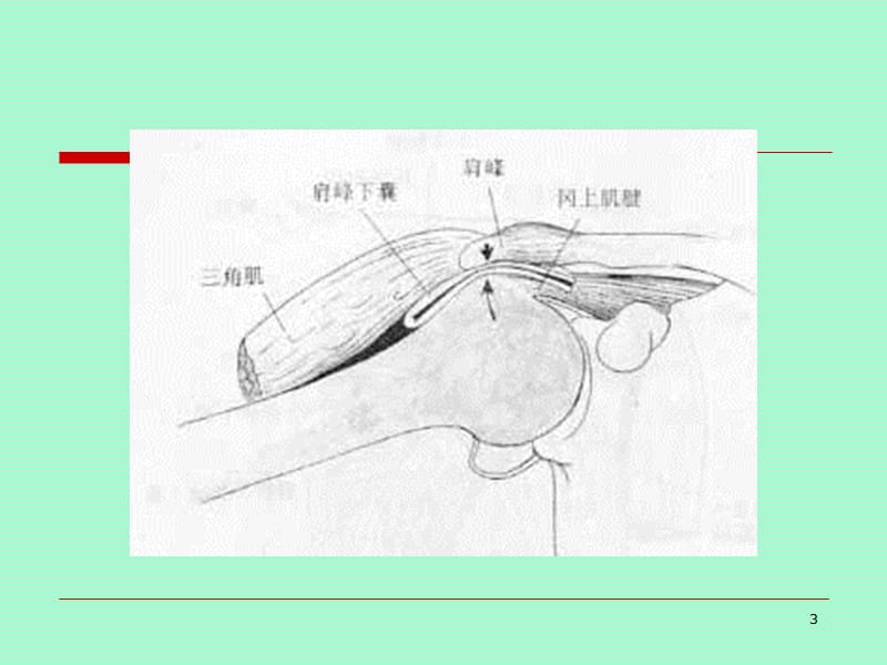 冈上肌腱炎PPT课件_第3页