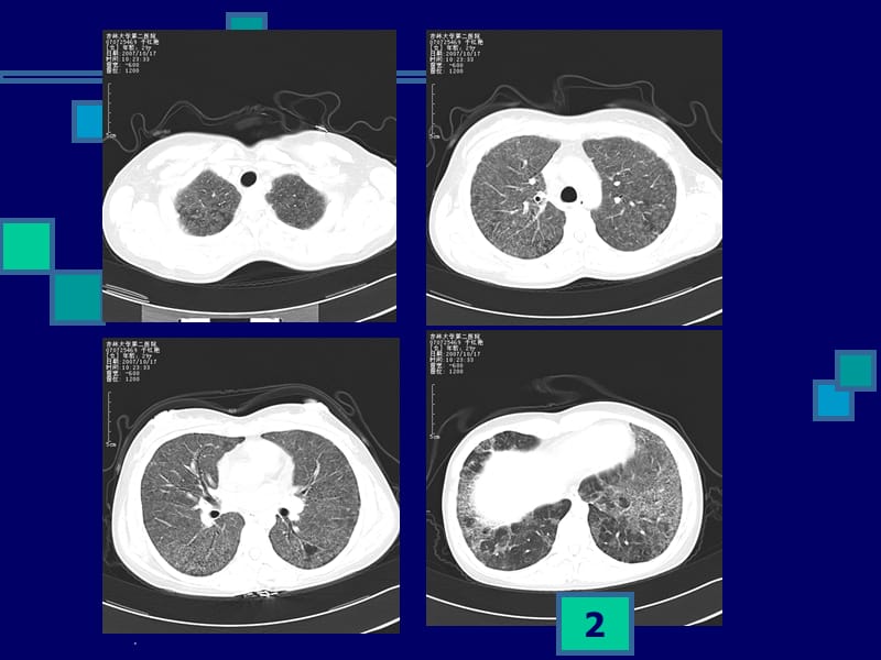 肺CT阅片PPT演示课件_第2页