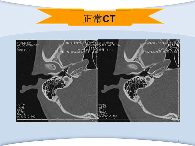 中耳炎理解PPT演示课件_第3页