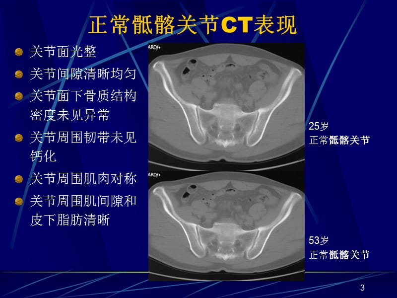 AS骶髂关节病变的CT诊断ppt课件_第3页