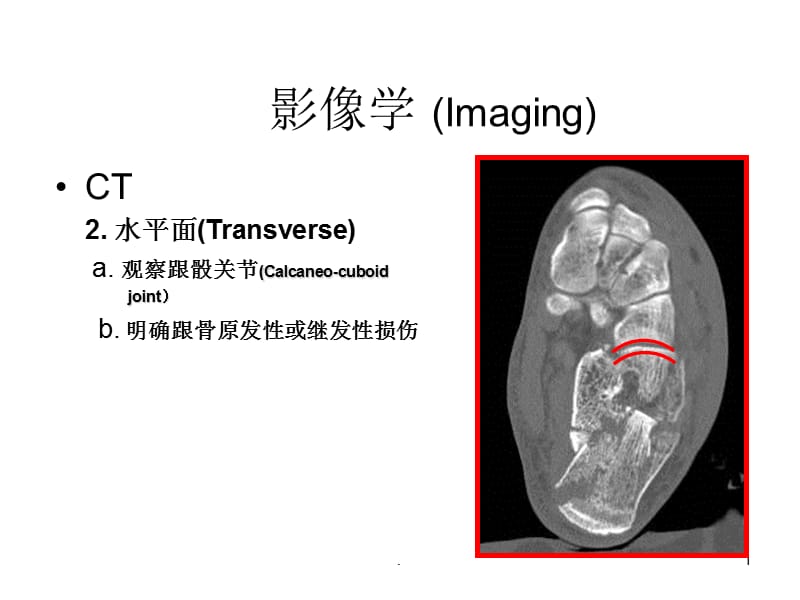 (医学文档)跟骨骨折影像学ppt演示课件_第1页