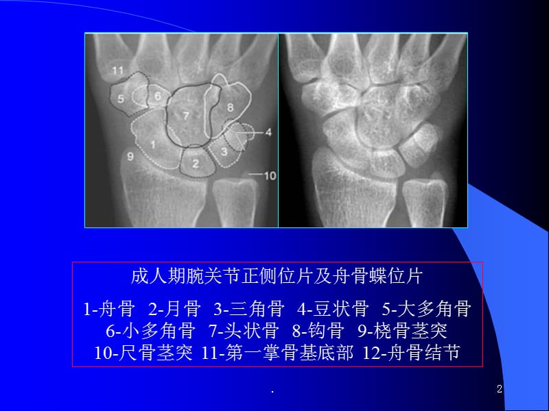 (医学课件)骨创伤腕关节解剖测量分析ppt演示课件_第2页