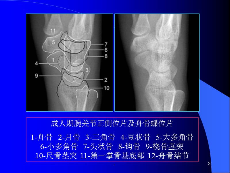 (医学课件)骨创伤腕关节解剖测量分析ppt演示课件_第3页