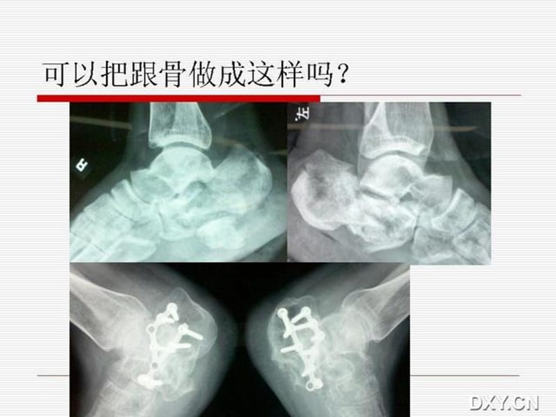 (医学文档)跟骨骨折复位ppt演示课件_第1页