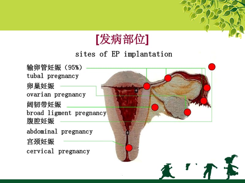 (医学课件)宫外孕ppt演示课件_第3页