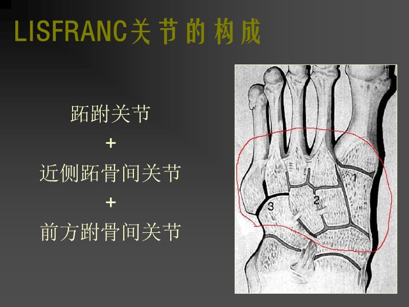 LISFRANC关节损伤PPT课件_第2页