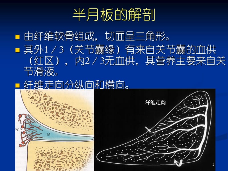 半月板撕裂的MR诊断PPT课件_第3页