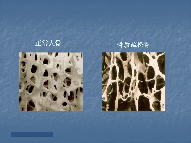 (医学课件)骨松与疼痛ppt演示课件_第3页