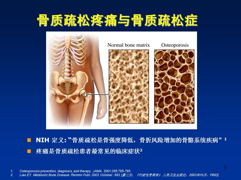 (医学课件)骨质疏松疼痛的机理及治疗ppt课件_第3页