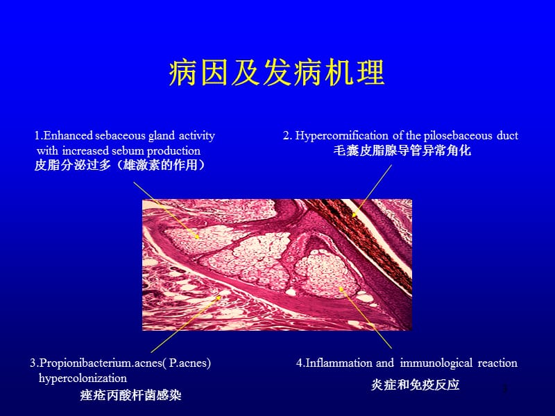 痤疮研究现状ppt课件_第3页