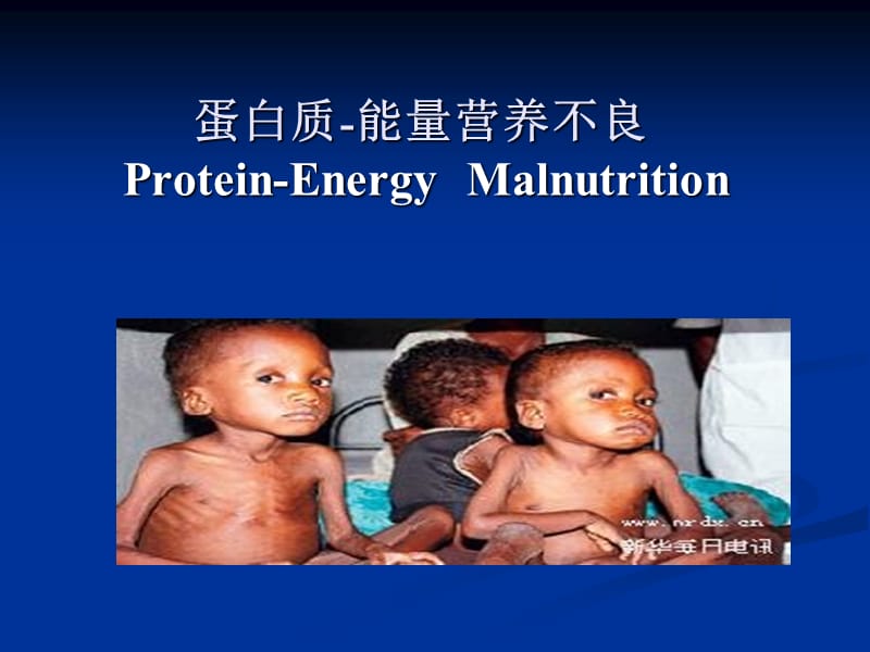 儿科蛋白质能量营养不良PPT课件_第1页