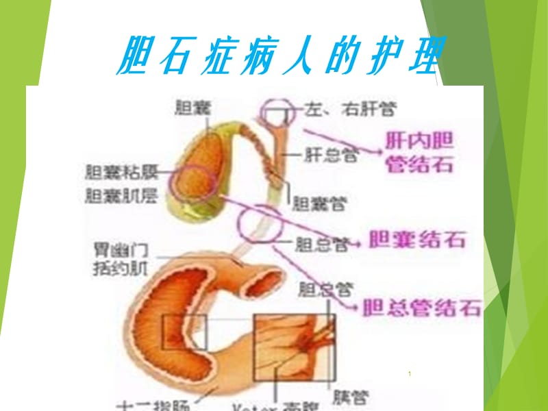 胆石症病人的护理PPT课件_第1页