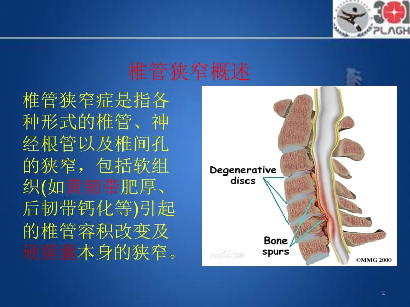 代谢性椎管狭窄PPT课件_第2页