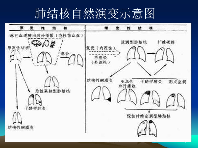 儿童结核病 ppt课件_第3页