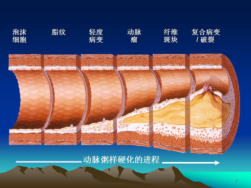 冠心病诊断与治疗指南PPT课件_第3页