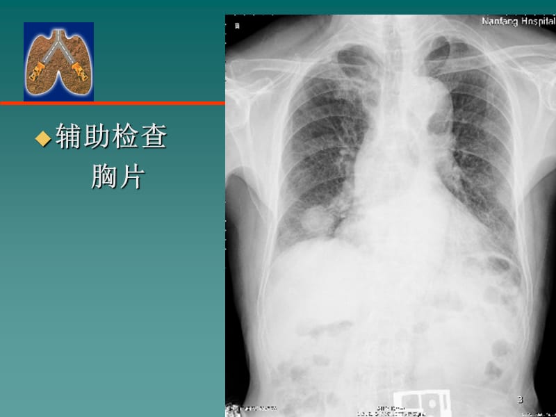 临床病例报告南方医院胸心外科ppt课件_第3页