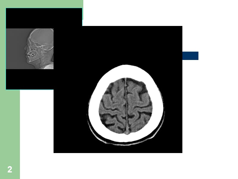颅脑CT诊断ppt课件_第2页