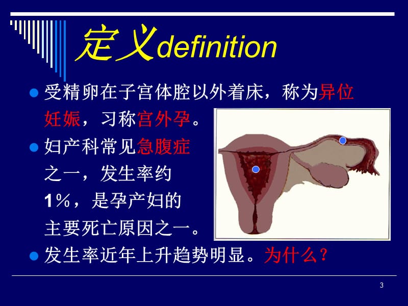 异位妊娠ppt课件_第3页