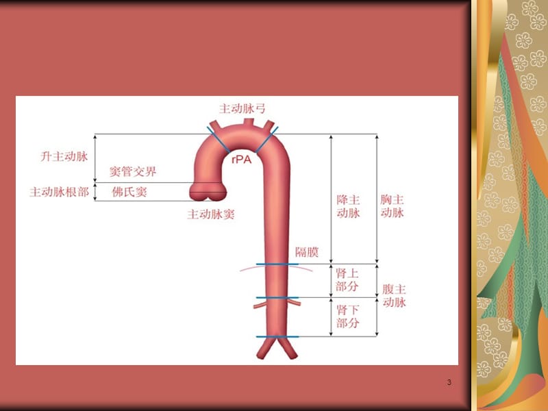 主动脉夹层的诊断与护理ppt课件_第3页