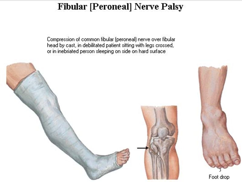 周围神经损伤ppt课件_第3页