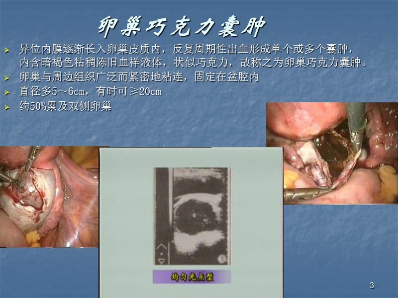 子宫内膜异位症和腺肌症ppt课件_第3页