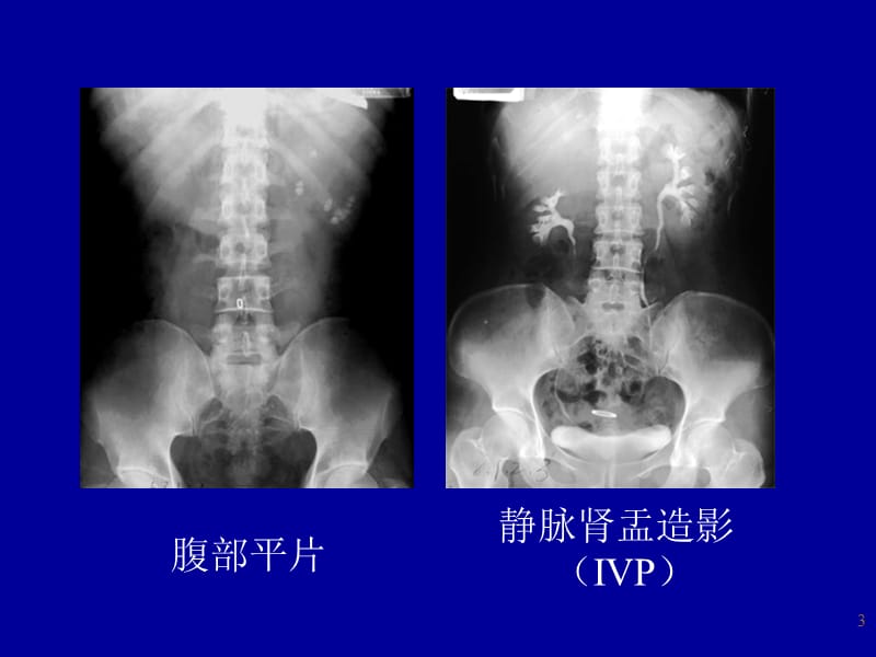 医学类医学影像学泌尿系统ppt课件_第3页