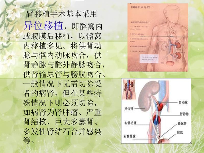 肾移植术后护理ppt课件_第3页