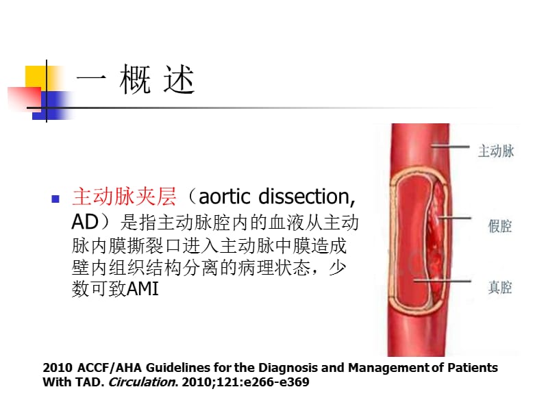 主动脉夹层致急性心梗的识别与处理ppt课件.ppt_第2页